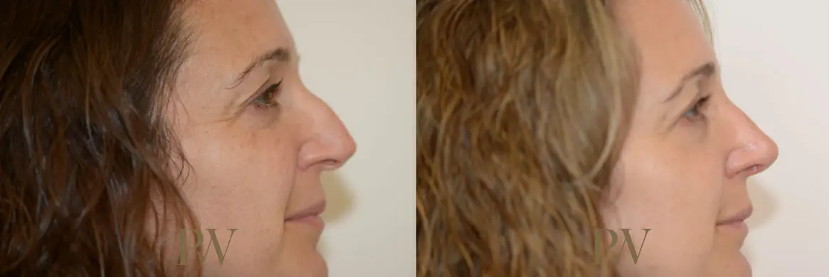 Paul Wilson - Rhinoplasty Patient Image 16