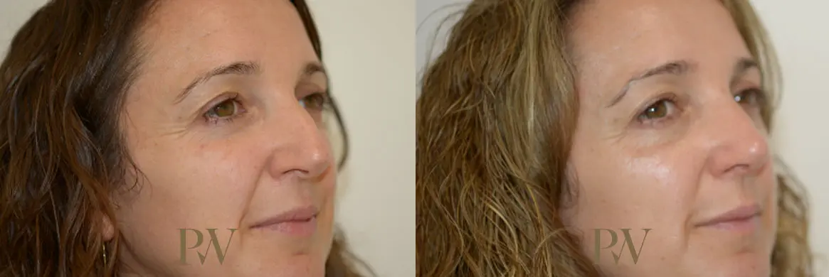 Paul Wilson - Rhinoplasty Patient Image 17