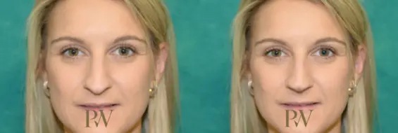 Paul Wilson - Rhinoplasty Patient Image 18