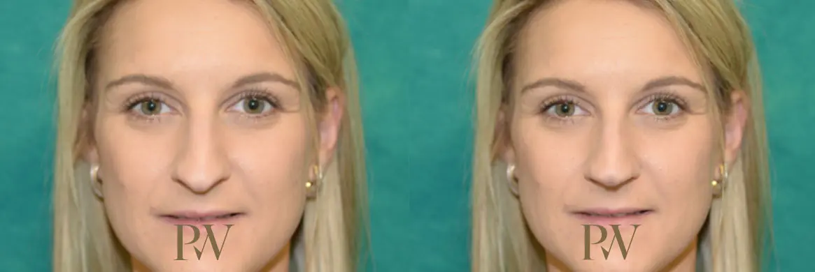 Paul Wilson - Rhinoplasty Patient Image 18