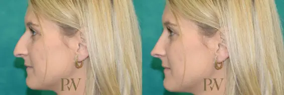 Paul Wilson - Rhinoplasty Patient Image 19