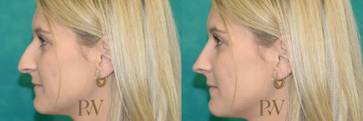 Paul Wilson - Rhinoplasty Patient Image 19