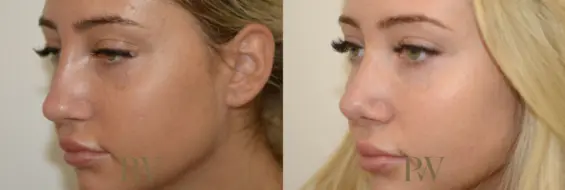 Paul Wilson - Rhinoplasty Patient Image 2