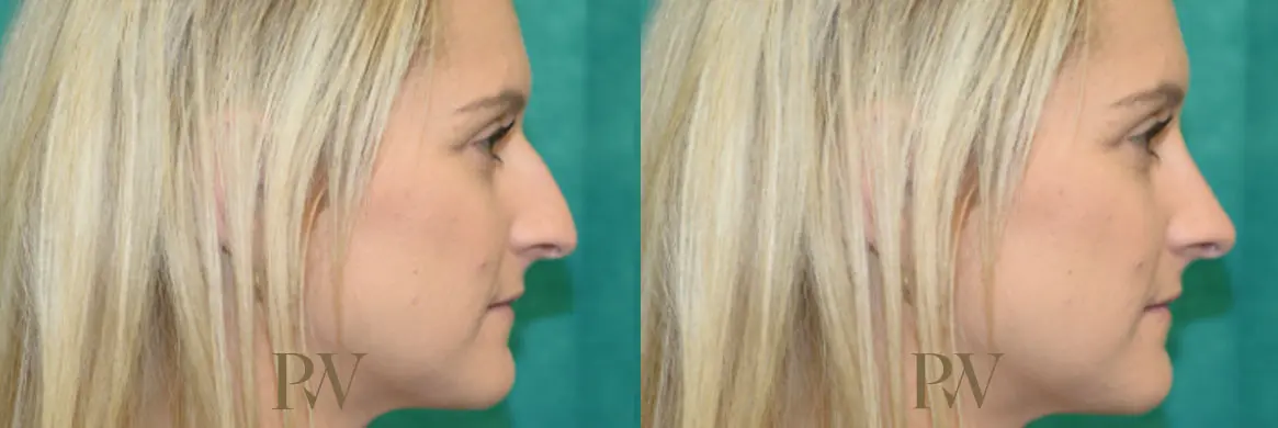 Paul Wilson - Rhinoplasty Patient Image 20