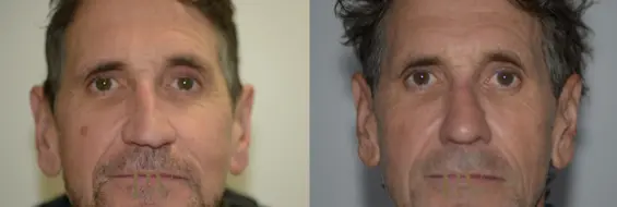 Paul Wilson - Rhinoplasty Patient Image 21