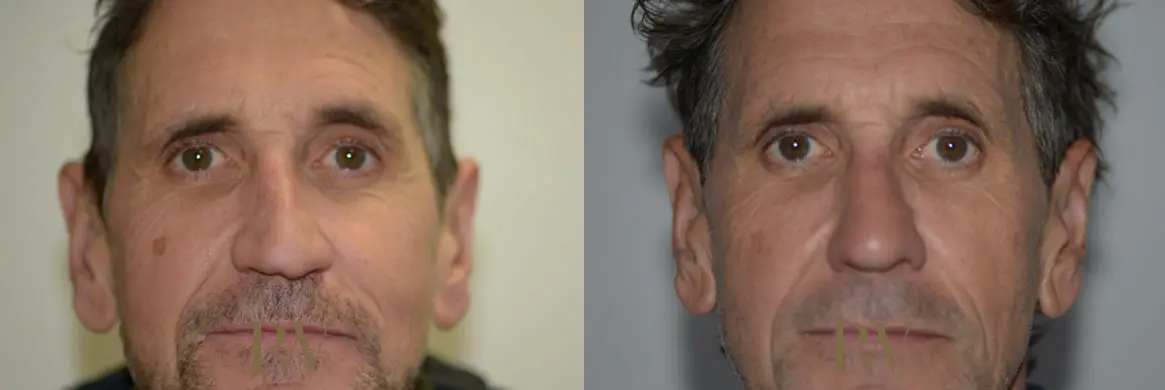 Paul Wilson - Rhinoplasty Patient Image 21