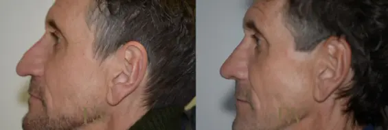 Paul Wilson - Rhinoplasty Patient Image 22