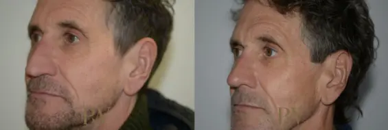 Paul Wilson - Rhinoplasty Patient Image 23