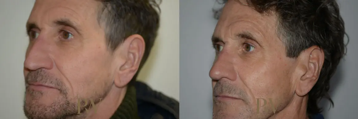 Paul Wilson - Rhinoplasty Patient Image 23