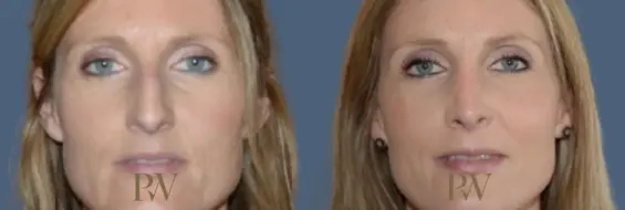 Paul Wilson - Rhinoplasty Patient Image 24