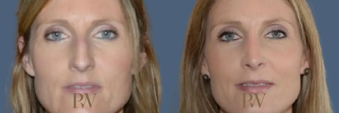 Paul Wilson - Rhinoplasty Patient Image 24