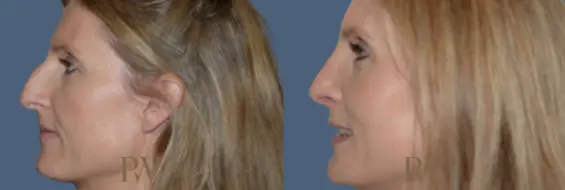 Paul Wilson - Rhinoplasty Patient Image 25