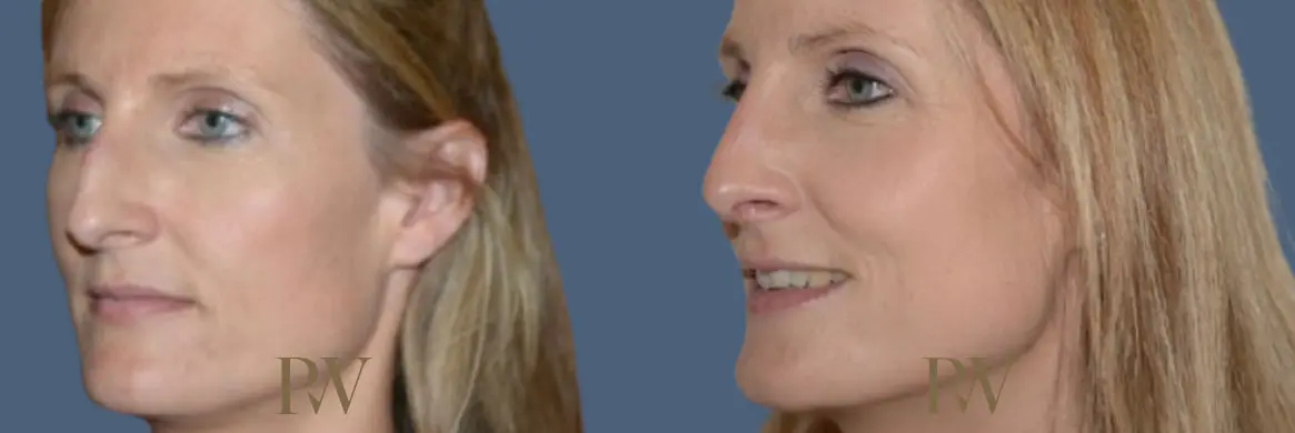 Paul Wilson - Rhinoplasty Patient Image 26