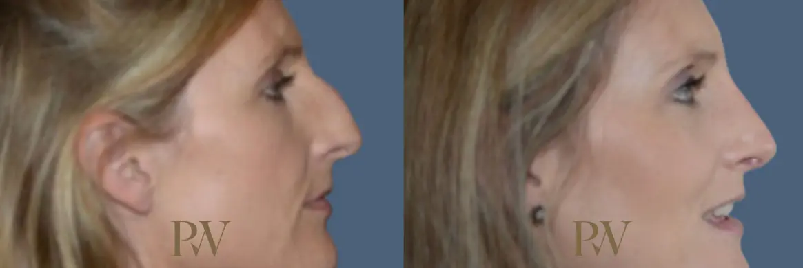 Paul Wilson - Rhinoplasty Patient Image 27