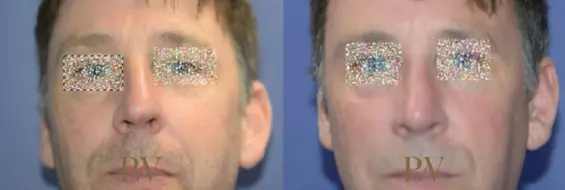 Paul Wilson - Rhinoplasty Patient Image 28