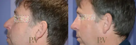 Paul Wilson - Rhinoplasty Patient Image 29