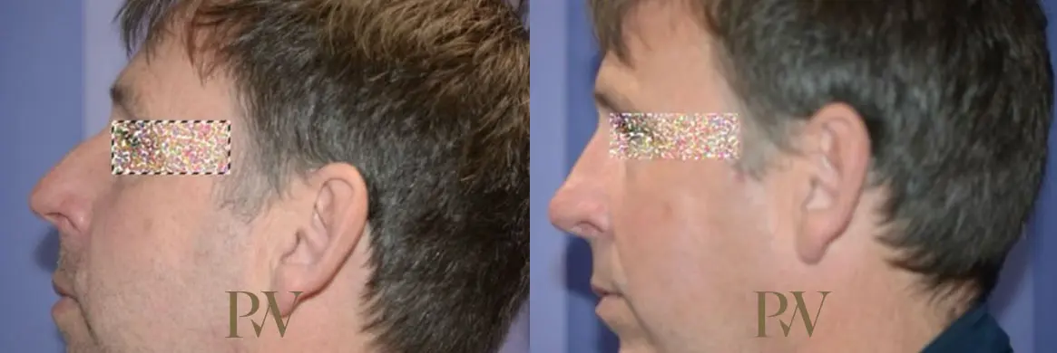 Paul Wilson - Rhinoplasty Patient Image 29
