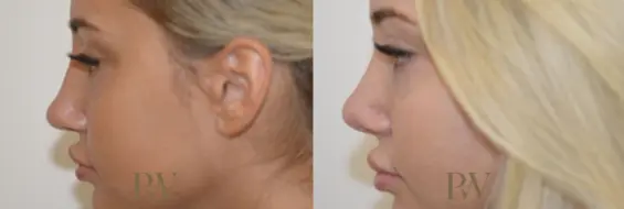 Paul Wilson - Rhinoplasty Patient Image 3