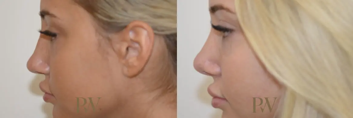 Paul Wilson - Rhinoplasty Patient Image 3