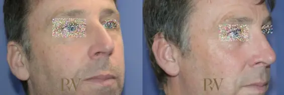 Paul Wilson - Rhinoplasty Patient Image 30