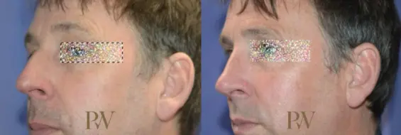 Paul Wilson - Rhinoplasty Patient Image 31