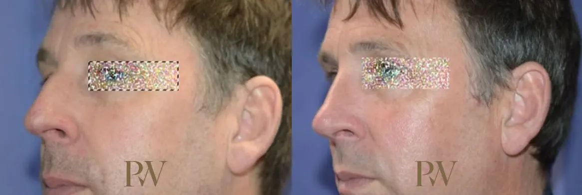 Paul Wilson - Rhinoplasty Patient Image 31