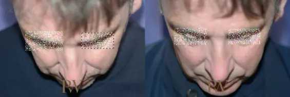 Paul Wilson - Rhinoplasty Patient Image 32