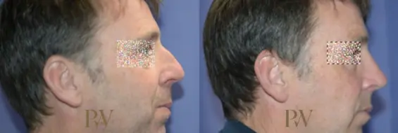 Paul Wilson - Rhinoplasty Patient Image 33