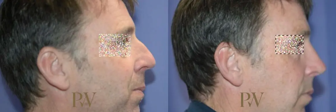 Paul Wilson - Rhinoplasty Patient Image 33