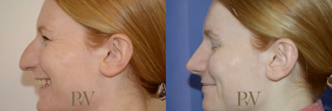 Paul Wilson - Rhinoplasty Patient Image 4