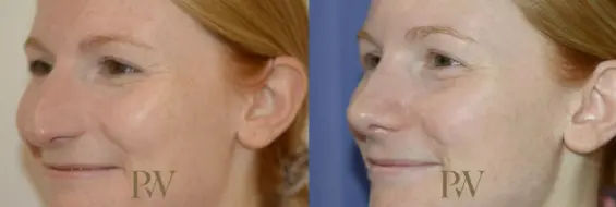 Paul Wilson - Rhinoplasty Patient Image 5