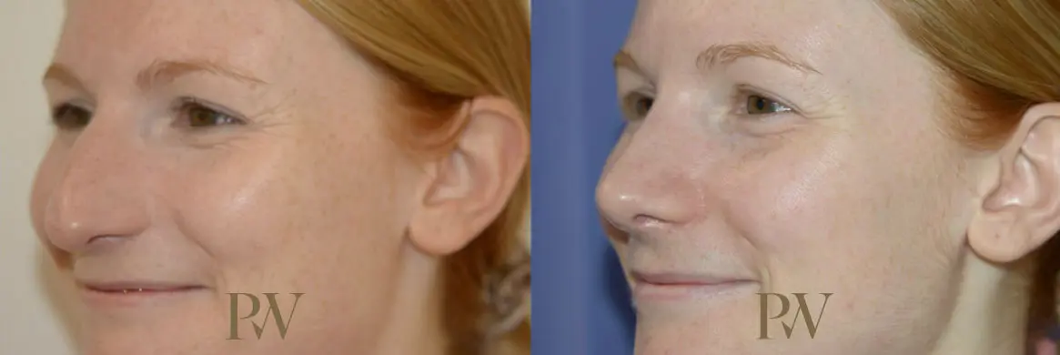 Paul Wilson - Rhinoplasty Patient Image 5