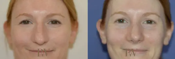 Paul Wilson - Rhinoplasty Patient Image 6