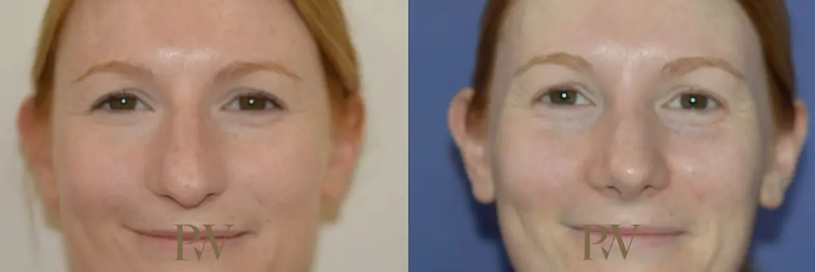 Paul Wilson - Rhinoplasty Patient Image 6