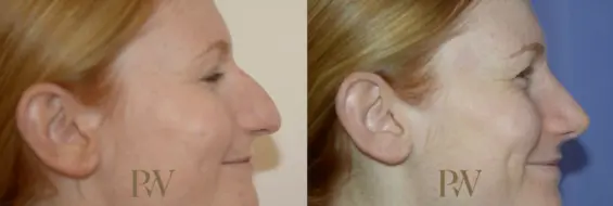 Paul Wilson - Rhinoplasty Patient Image 7