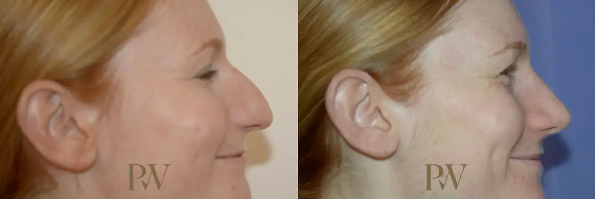 Paul Wilson - Rhinoplasty Patient Image 7