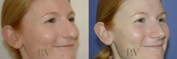 Paul Wilson - Rhinoplasty Patient Image 8