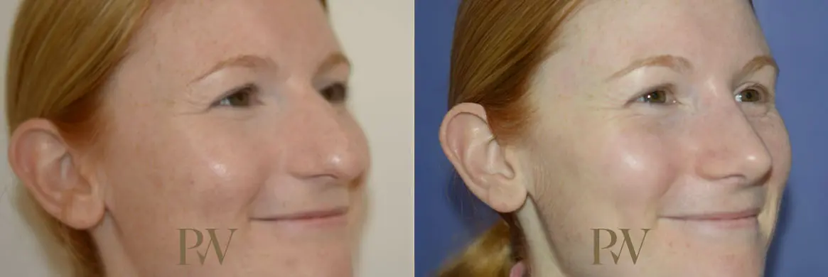 Paul Wilson - Rhinoplasty Patient Image 8