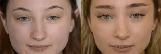 Paul Wilson - Rhinoplasty Patient Image 9