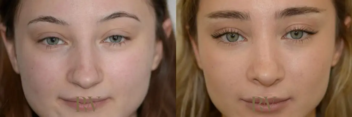 Paul Wilson - Rhinoplasty Patient Image 9