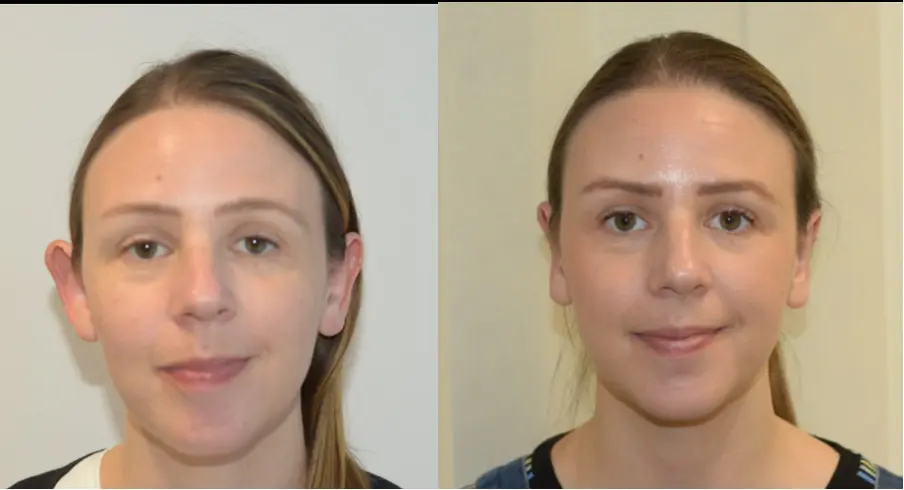 Otoplasty Surgery | Ears Pinned Back Surgery | Otoplasty Procedure