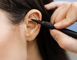 Otoplasty Surgery | Otoplasty | Otoplasty Cost UK