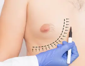 Gynecomastia Surgery | Gynecomastia Surgery Cost | Male Breast Reduction Surgery