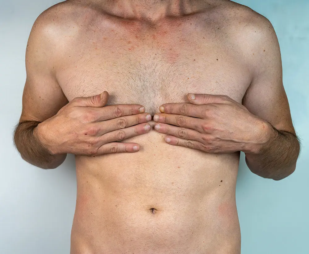 Gynecomastia Surgery | Gynecomastia Surgery Cost | Male Breast Reduction