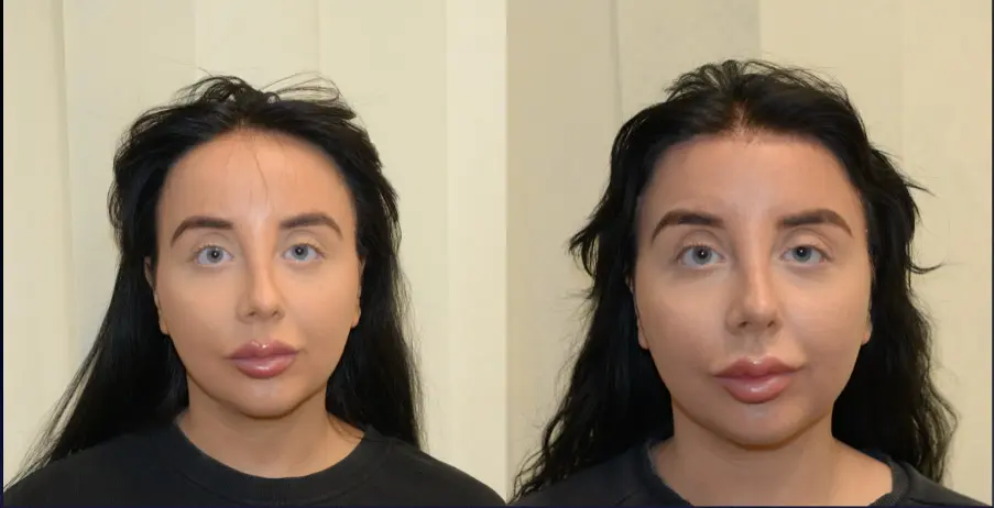 Forehead Reduction Surgery | Foreheadplasty | Hairline Lowering Surgery Cost UK