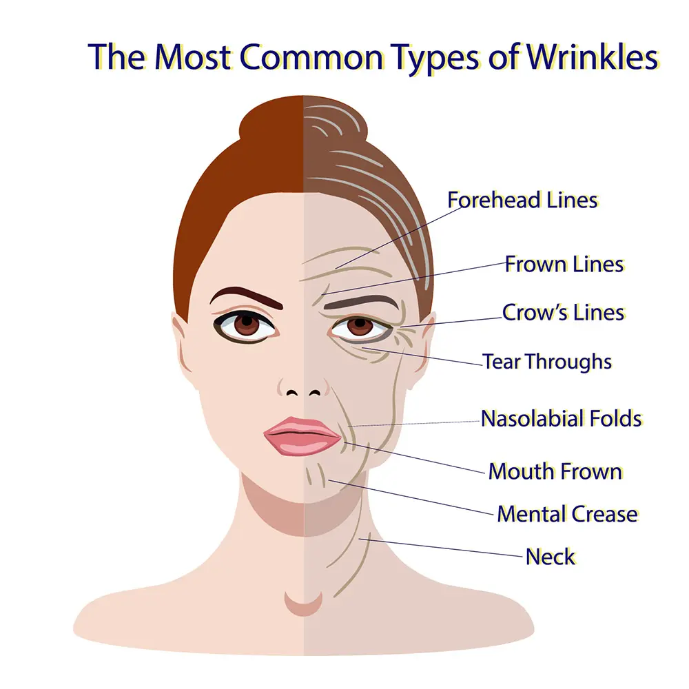 Anti Wrinkle Injections | Wrinkle Reduction Injections | Anti Wrinkle Treatment