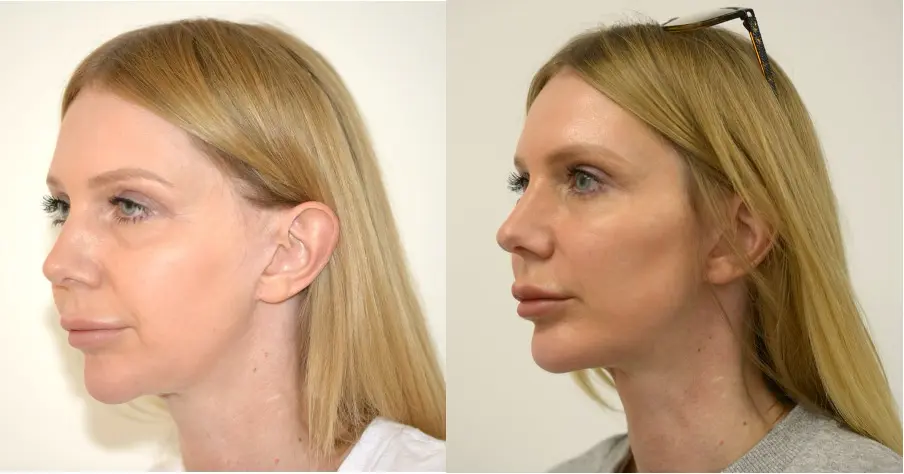 Facial Implants | Types of Facial Implants | Chin Implants | Jaw Implants