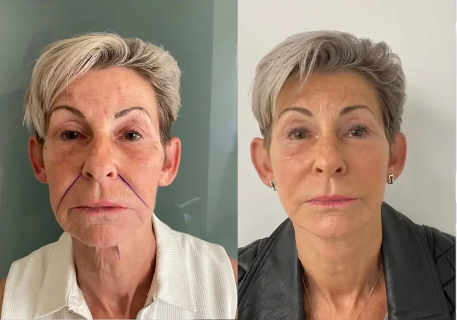 Mid Facelift | Cheek Lift | Mid Cheek Lift