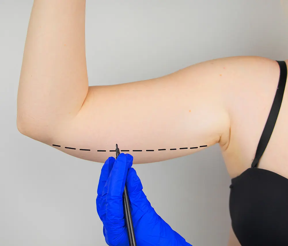 Arm Lift Surgery | Brachioplasty | Arm Reduction Surgery