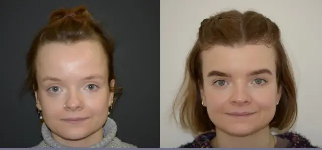 Forehead Reduction Surgery | Foreheadplasty | Hairline Lowering Surgery Cost